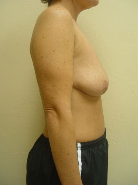 breast lift options