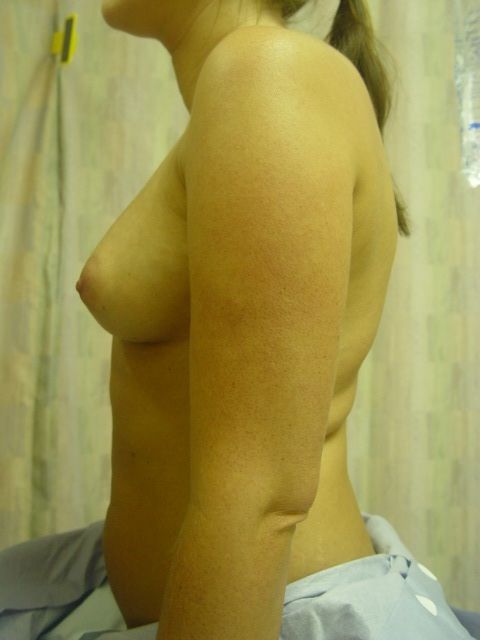 breast augmentation options