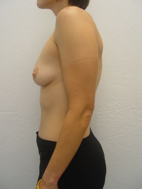 breast augmentation options